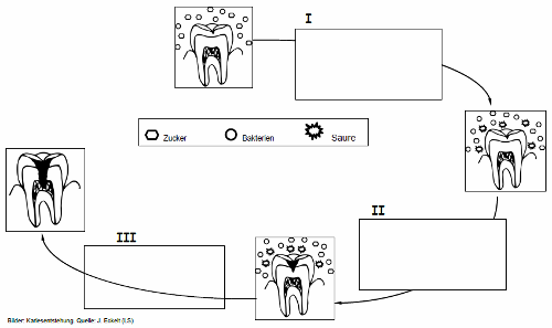 Entstehung von Karies