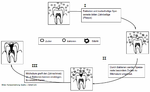 Lösung Entstehung von Karies